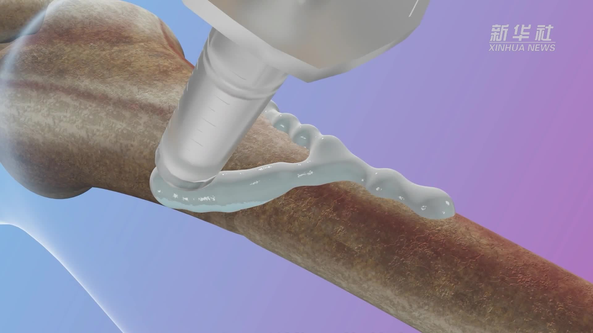 นักวิจัยจีนพัฒนา 'กาวติดกระดูก' แนวทางใหม่รักษากระดูกหัก